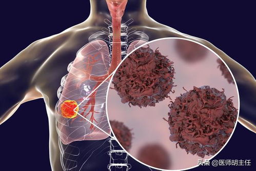 肩胛骨肿瘤介入栓塞费用 肩胛骨肿瘤介入栓塞费用