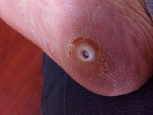 有脑肿瘤能吃阿胶糕吗 有脑肿瘤能吃阿胶糕吗